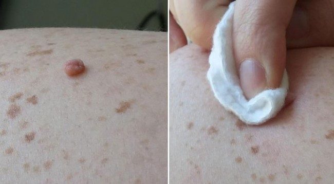 Ja si mund t’i largoni lythat pa dhimbje – me vetëm një përbërës që e keni në shtëpi
